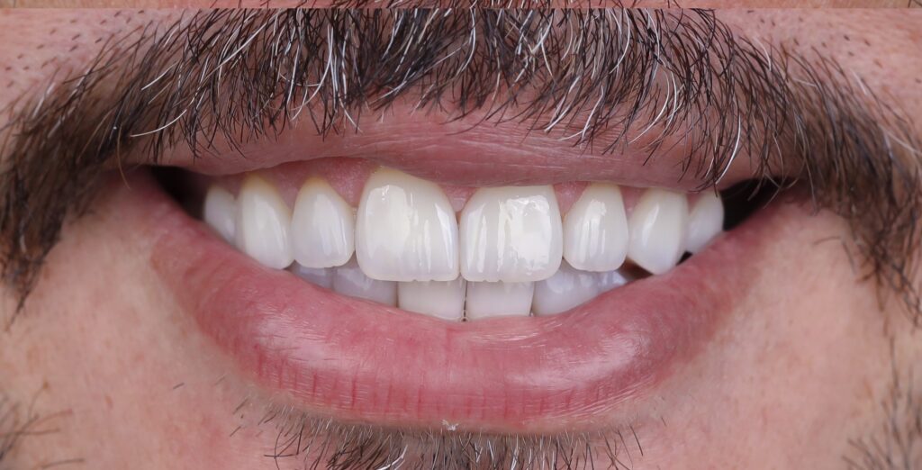 Composite bonding after
