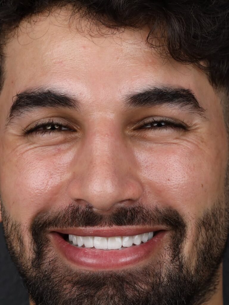 Porcelain veneers after