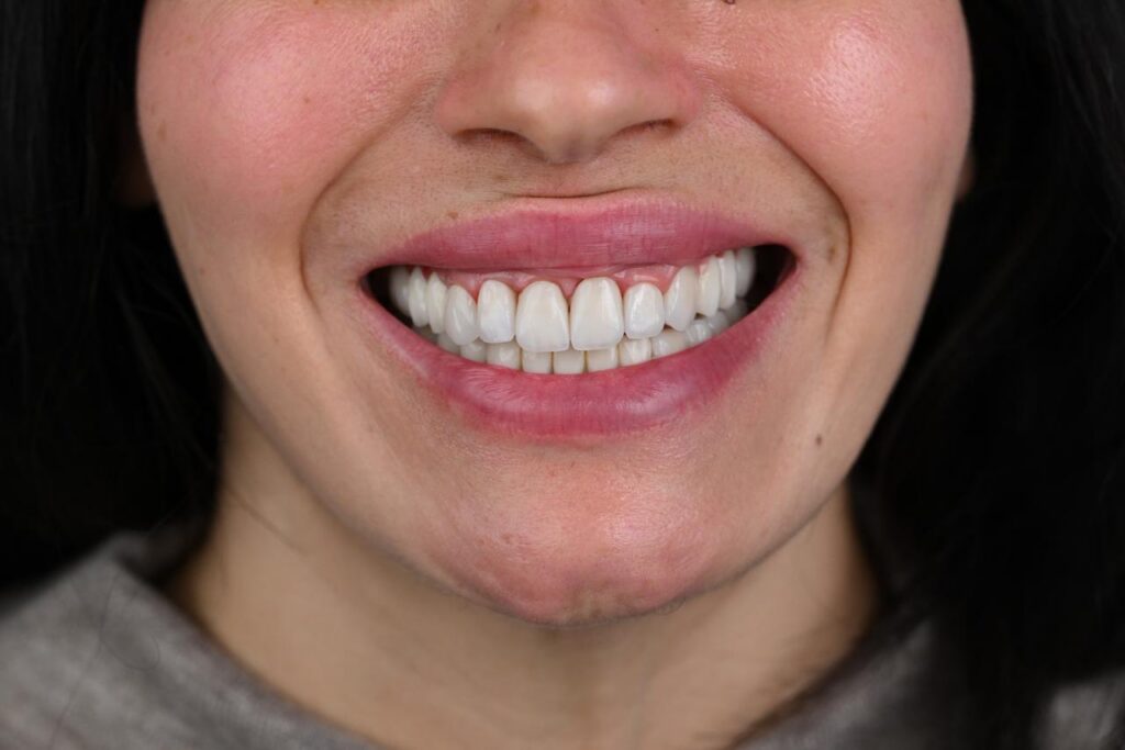 Implants after
