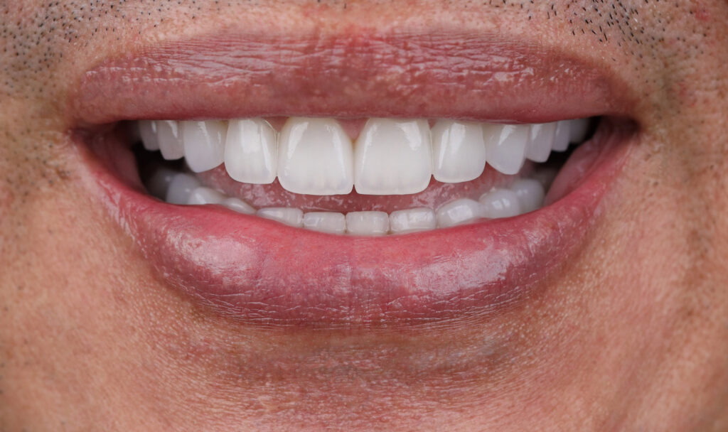 Porcelain veneers after