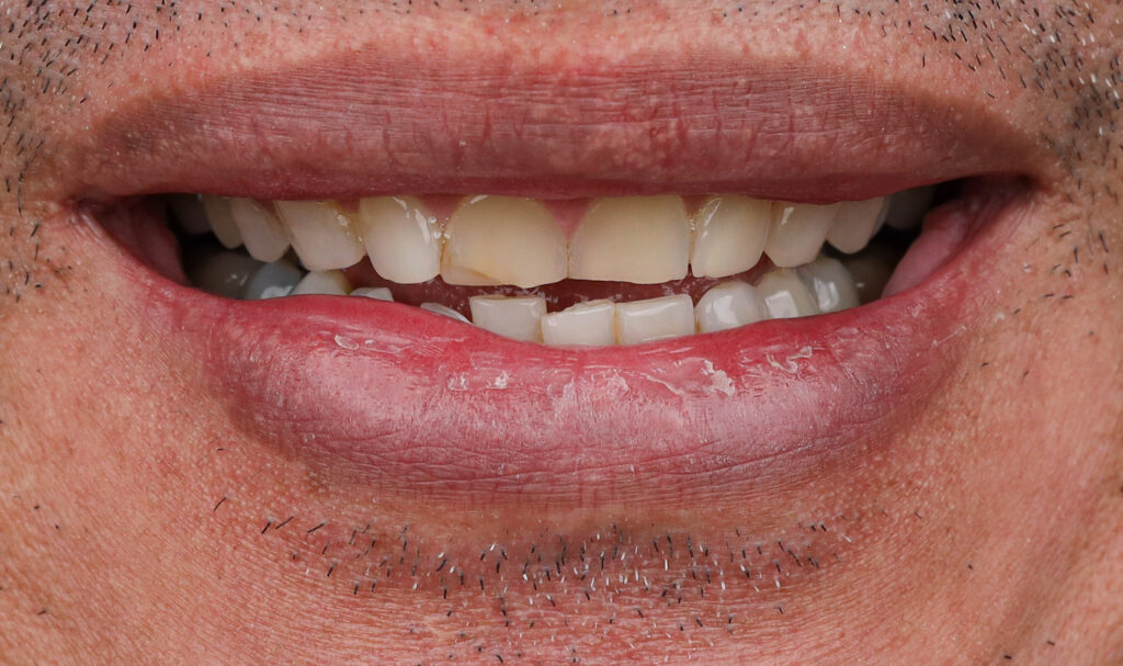 Porcelain veneers before