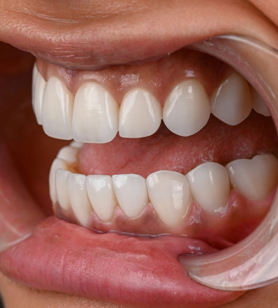Implants after