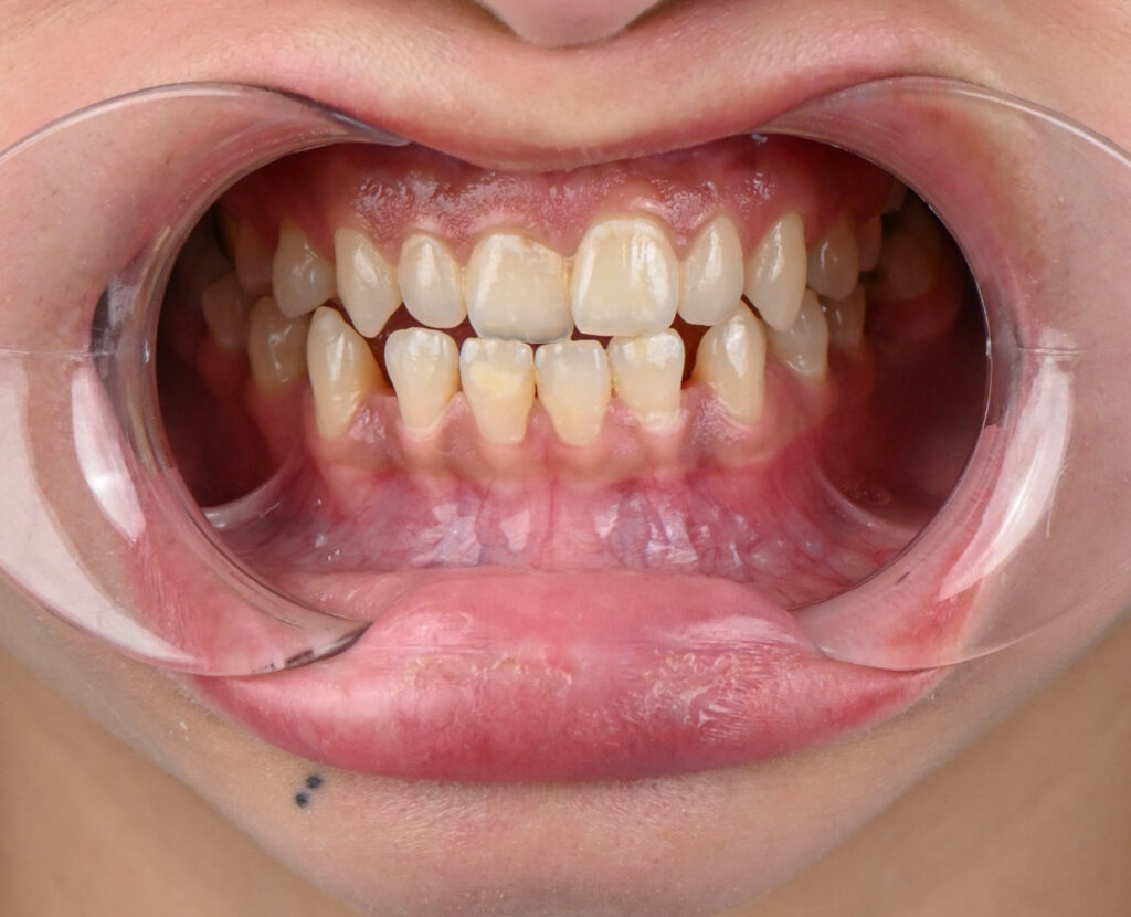 Implants before