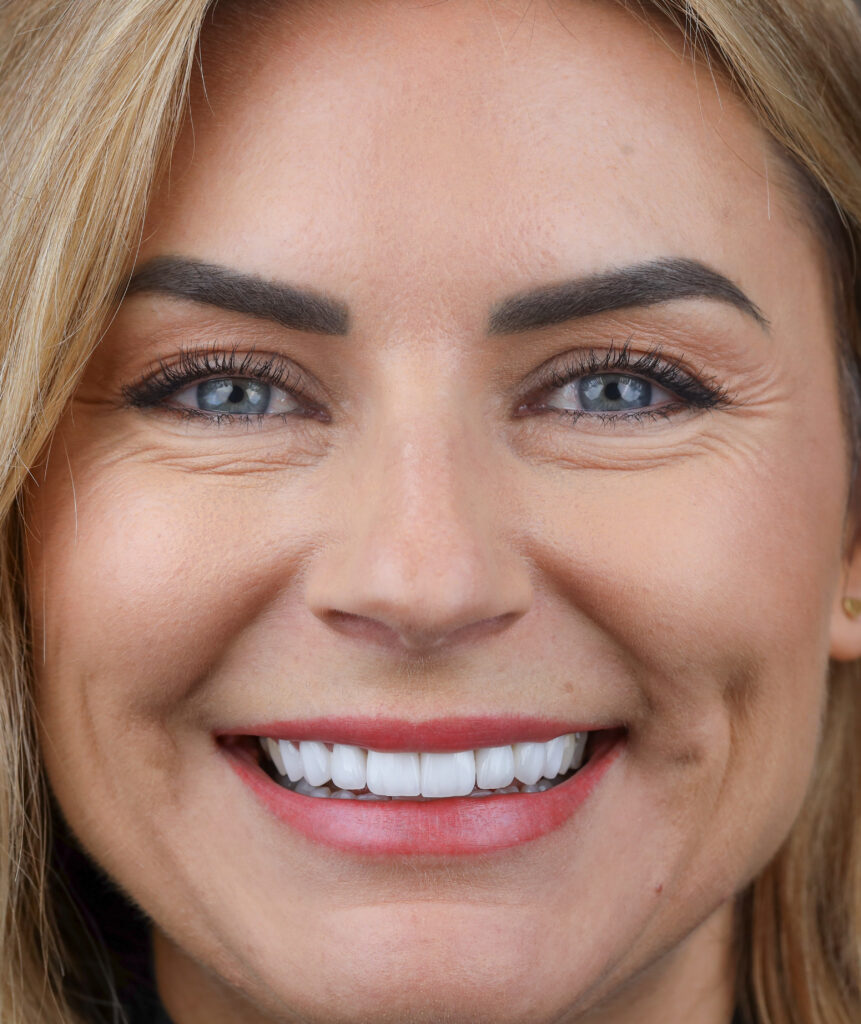 Porcelain veneers after
