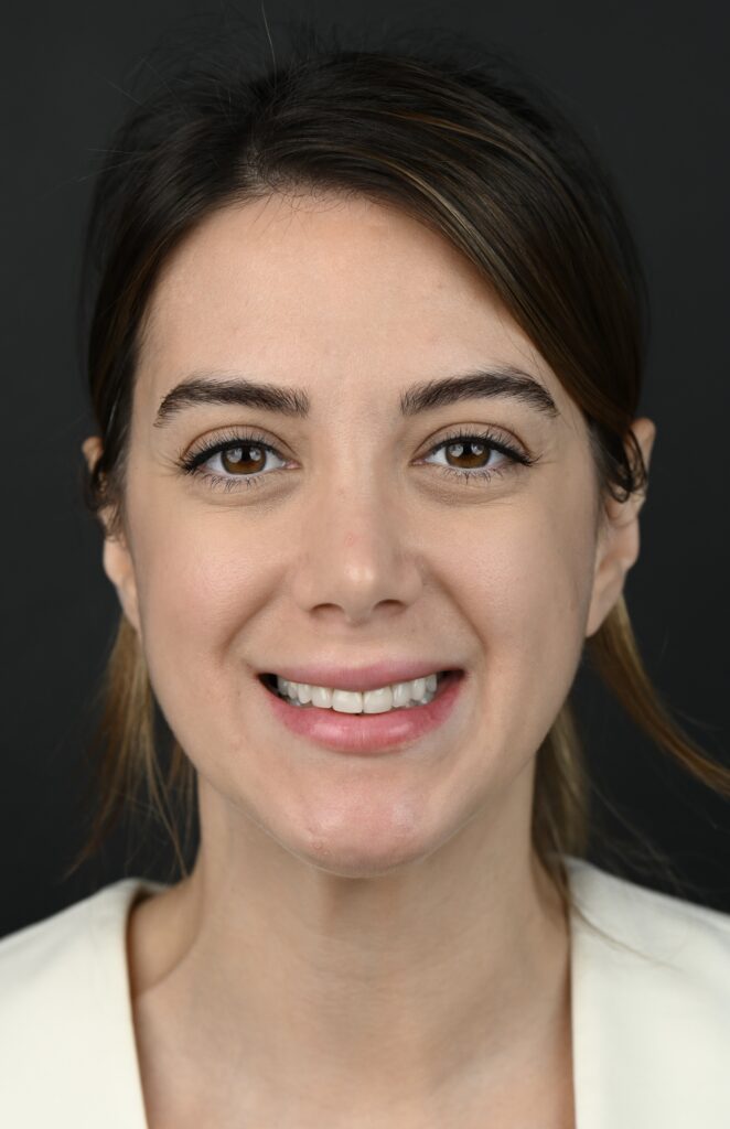 Invisalign before