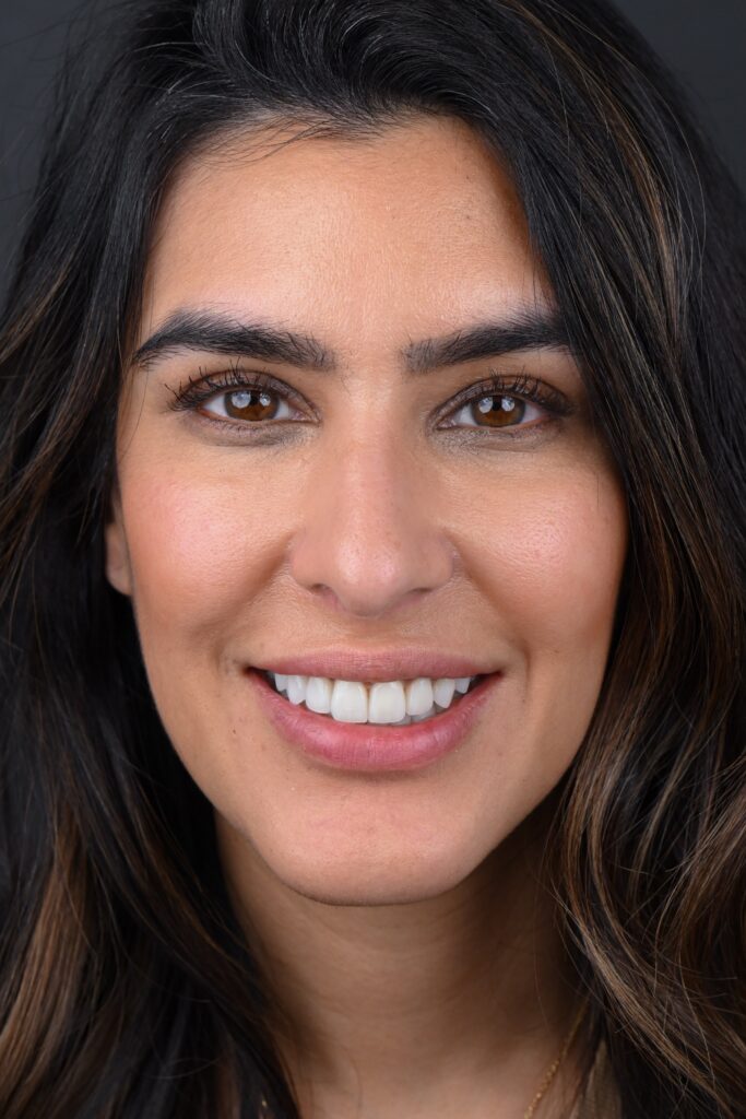 Porcelain veneers after